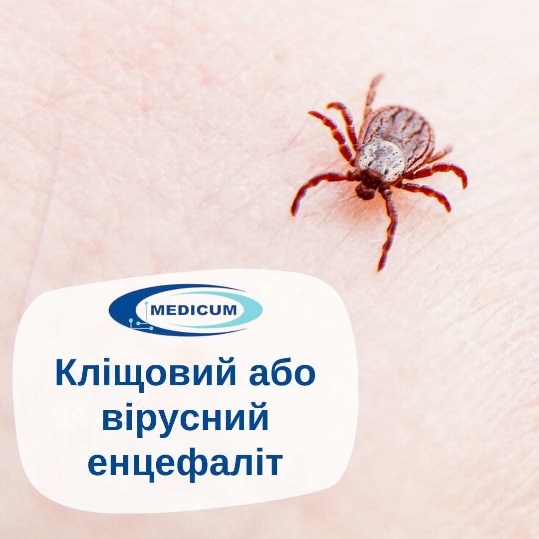 Кліщовий або вірусний енцефаліт